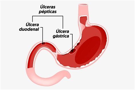 Úlcera duodenal